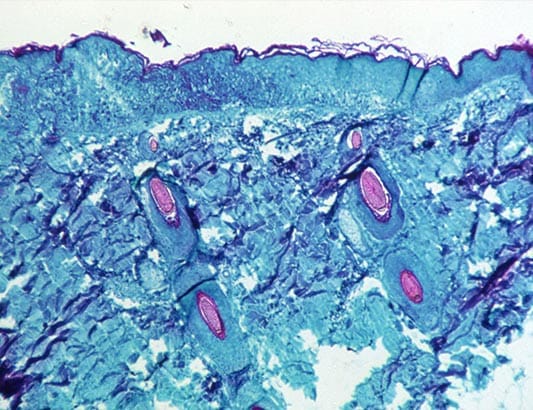 10 điều cần biết về bệnh đậu mùa khỉ