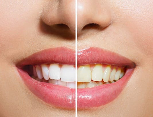 Cao răng là gì? Có nên lấy cao răng thường xuyên?