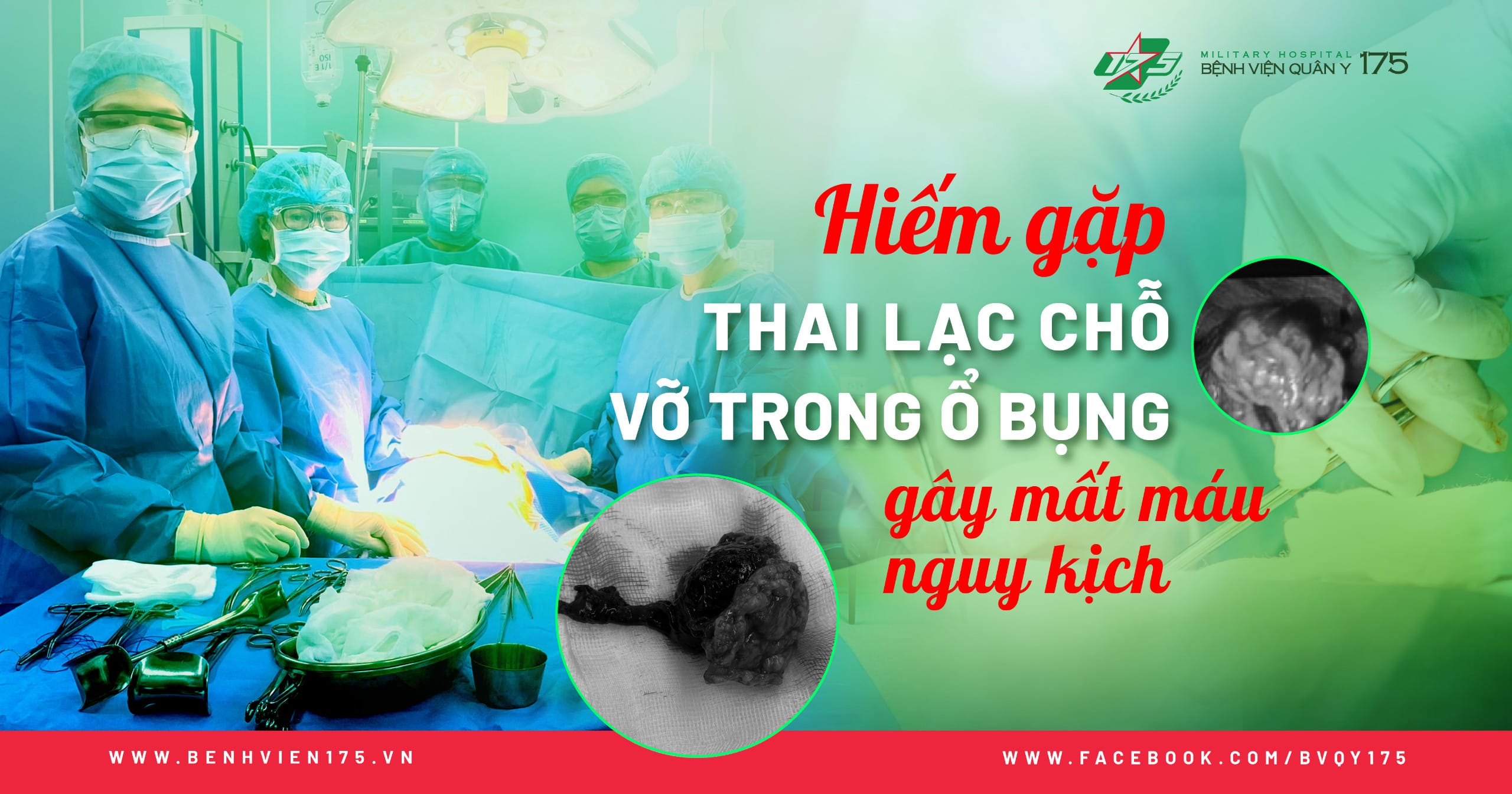 Hiếm gặp: Thai lạc chỗ vỡ trong ổ bụng gây mất máu nguy hiểm tính mạng
