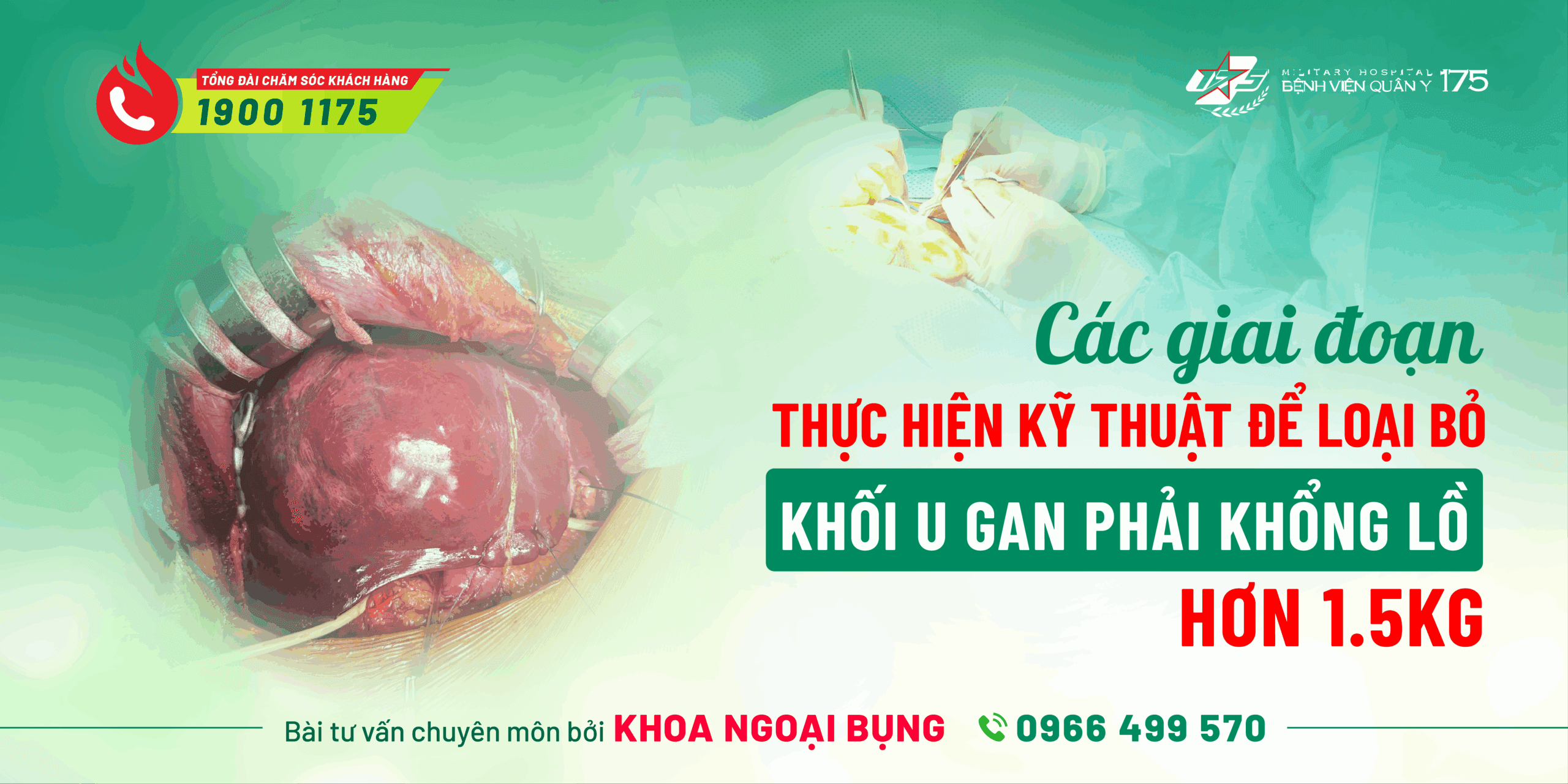 Thực hiện thành công Kỹ thuật cắt gan Hai giai đoạn (TWO-STAGES HEPATECTOMY) để điều trị khối u gan khổng lồ