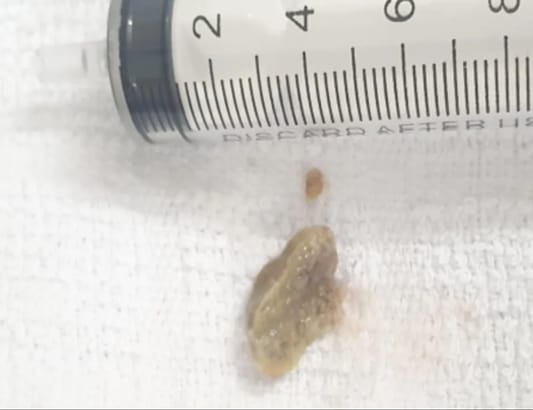 Người đàn ông bị viêm phổi nặng do hóc xương