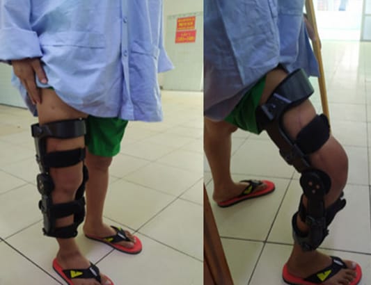 Ngâm xương trong ni-tơ lạnh, tái ghép cứu đôi chân chàng trai bị ung thư