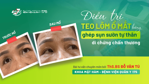 Điều trị teo lõm ổ mắt bằng ghép sụn sườn tự thâm đi chứng chấn thương