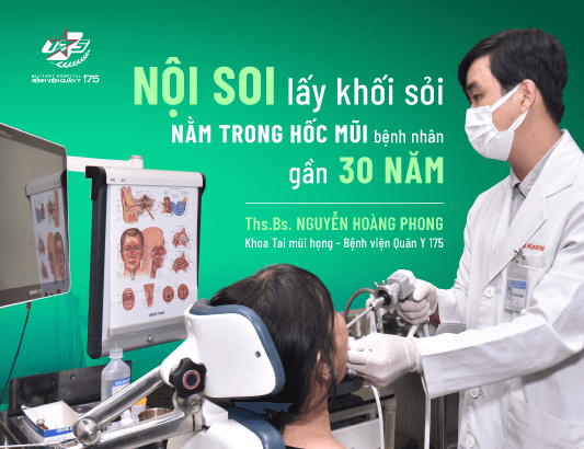 Nội soi lấy khối sỏi nằm trong hốc mũi bệnh nhân gần 30 năm