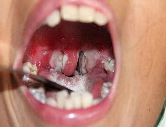 Không chủ quan trước bệnh bạch hầu