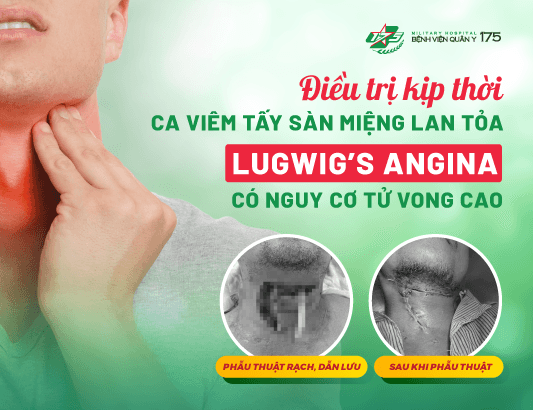 Điều trị kịp thời ca viêm tấy sàn miệng lan tỏa Lugwig’s angina có nguy cơ tử vong cao