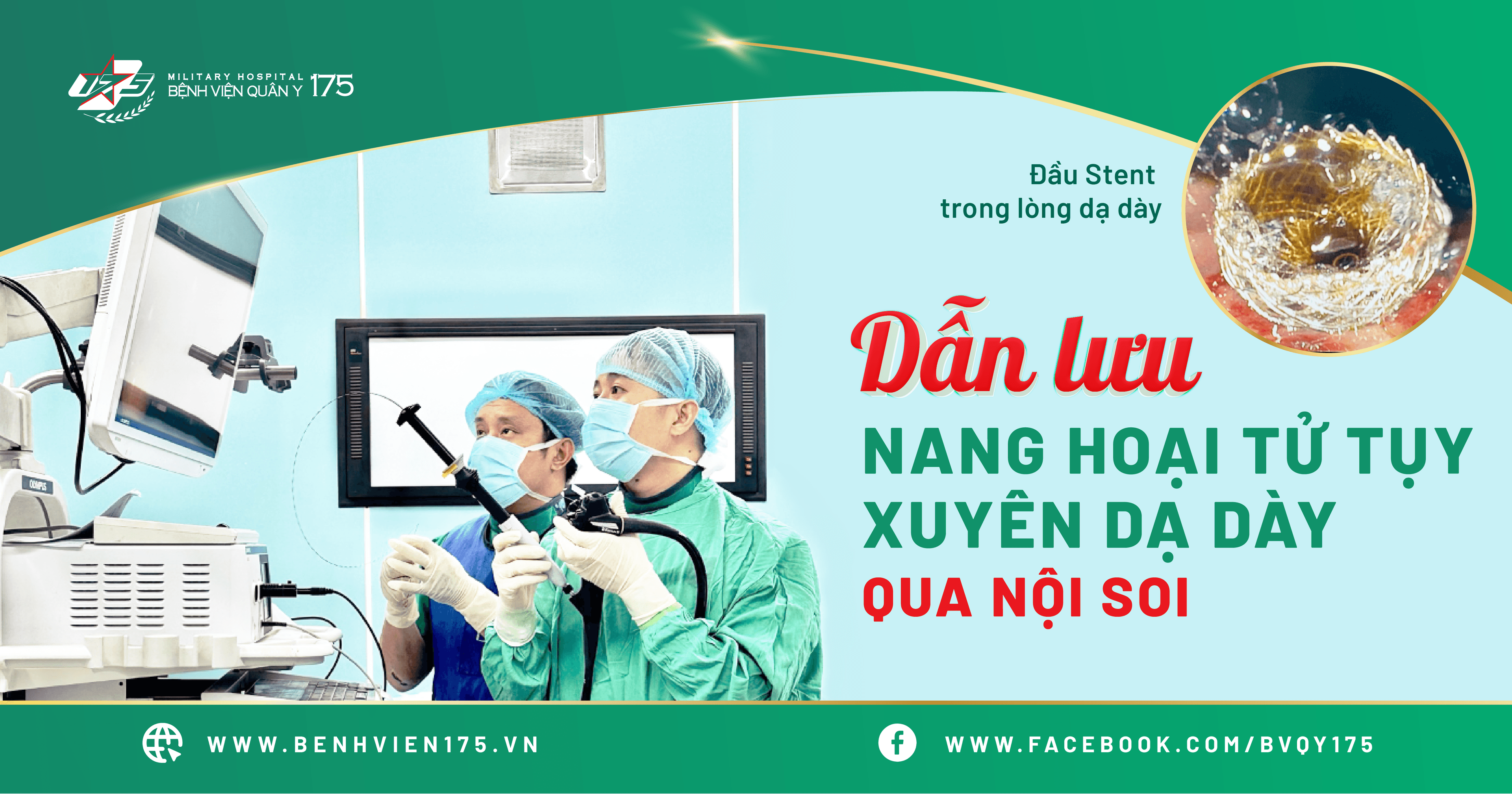 Dẫn lưu nang hoại tử tụy xuyên dạ dày qua nội soi