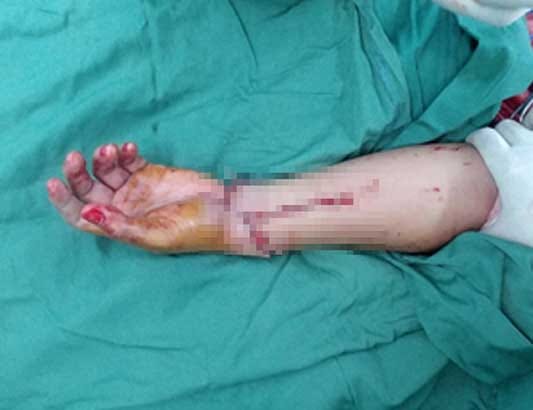 TP.HCM: Nối thành công cánh tay bị chém đứt lìa bằng mã tấu