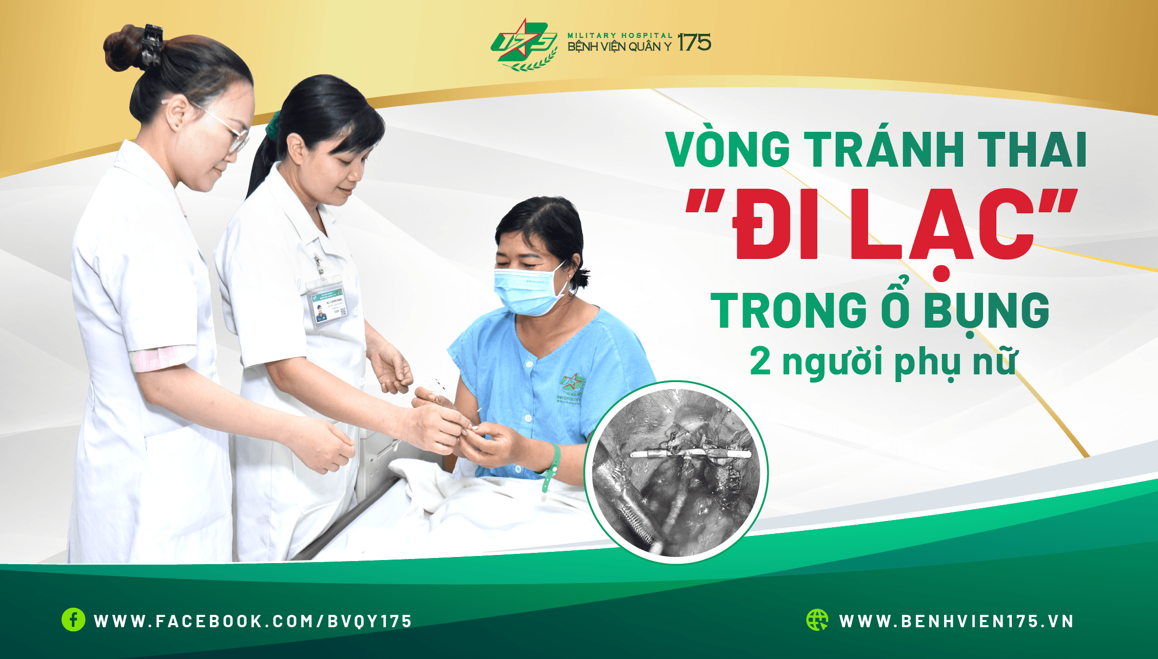 Phẫu thuật lấy vòng tránh thai lạc trong ổ bụng 2 người phụ nữ