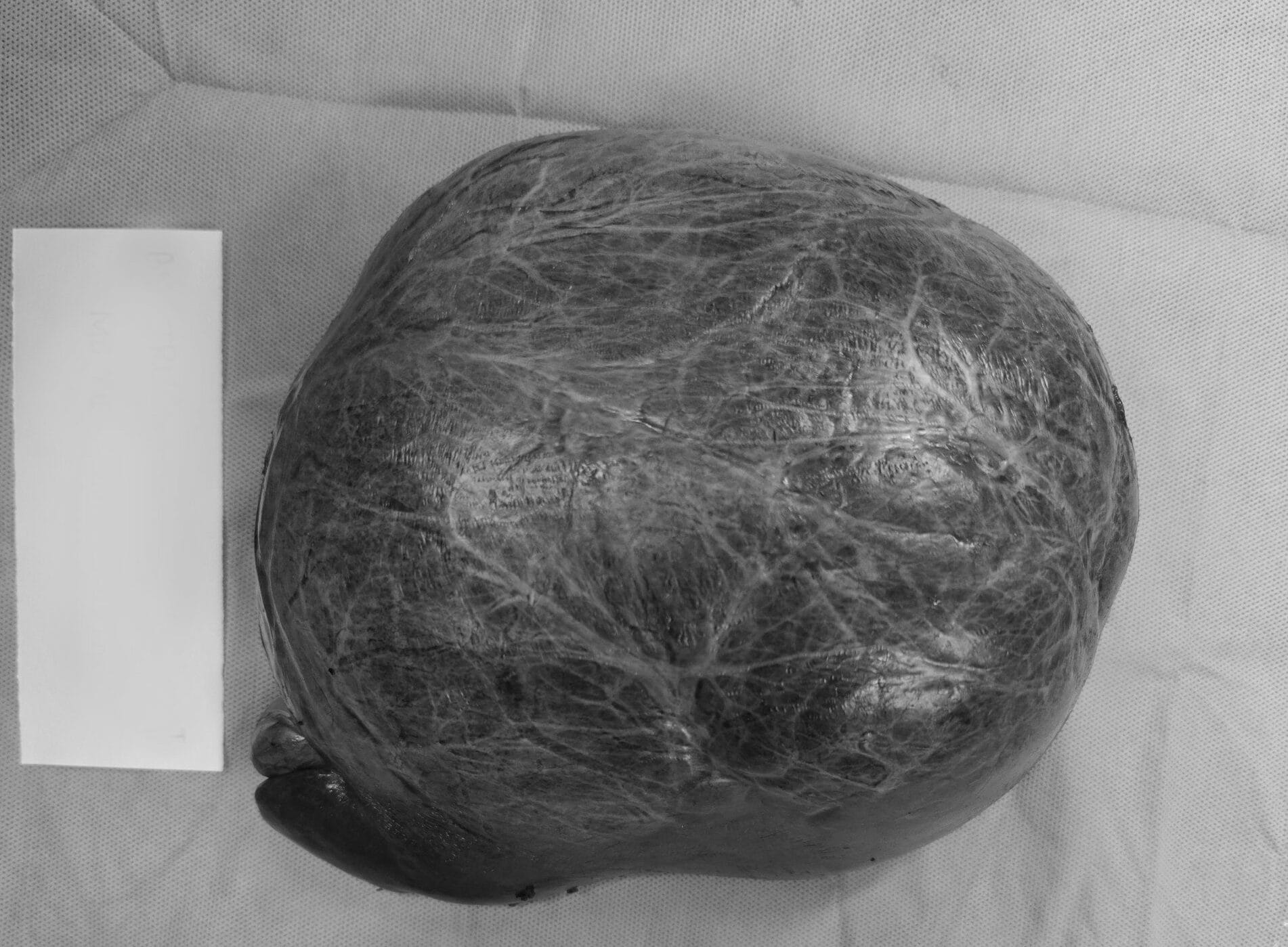 Phẫu thuật thành công khối u gan khổng lồ hiếm gặp nặng tới 3kg ở một bệnh nhân nữ trẻ tuổi