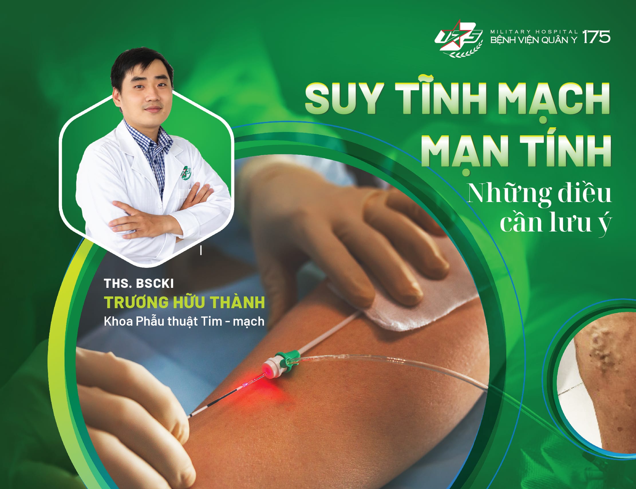 Suy tĩnh mạch mạn tính – Những điều cần lưu ý