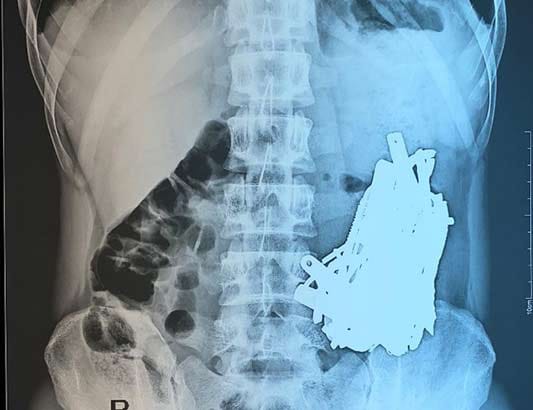 Bác sĩ 'choáng' khi phát hiện vô số đinh, thìa, lưỡi dao trong bụng nam bệnh nhân