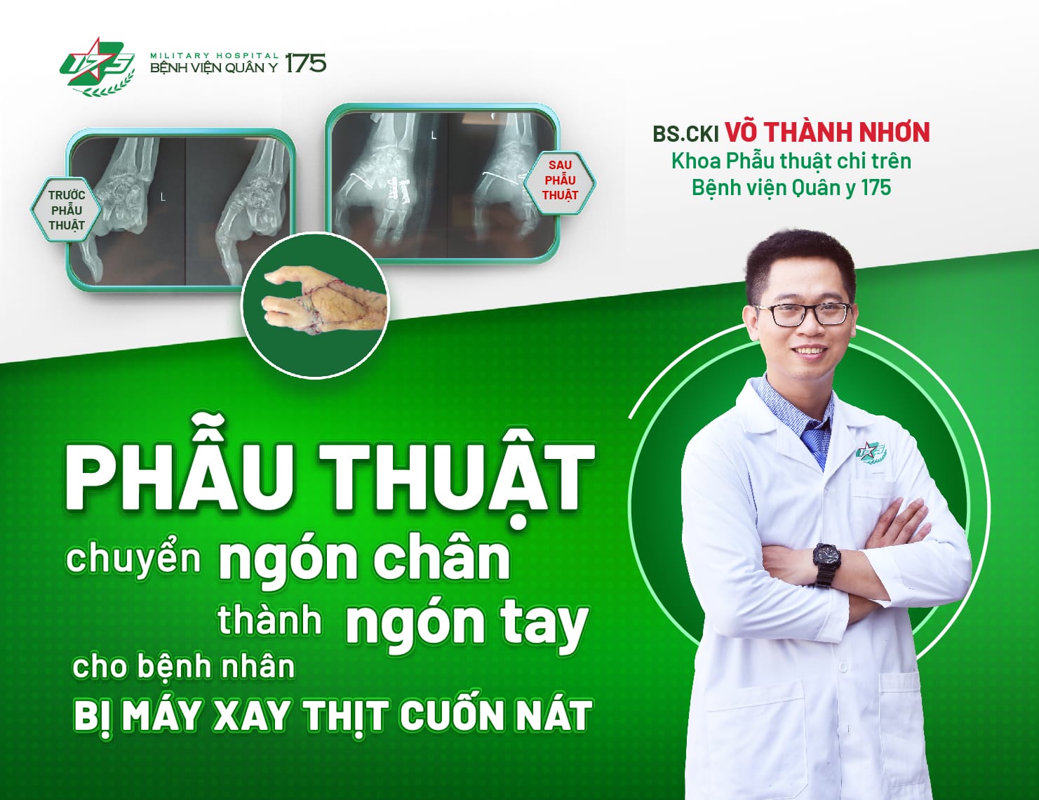 Phẫu thuật chuyển ngón chân thành ngón tay cho bệnh nhân bị máy xay thịt cuốn nát