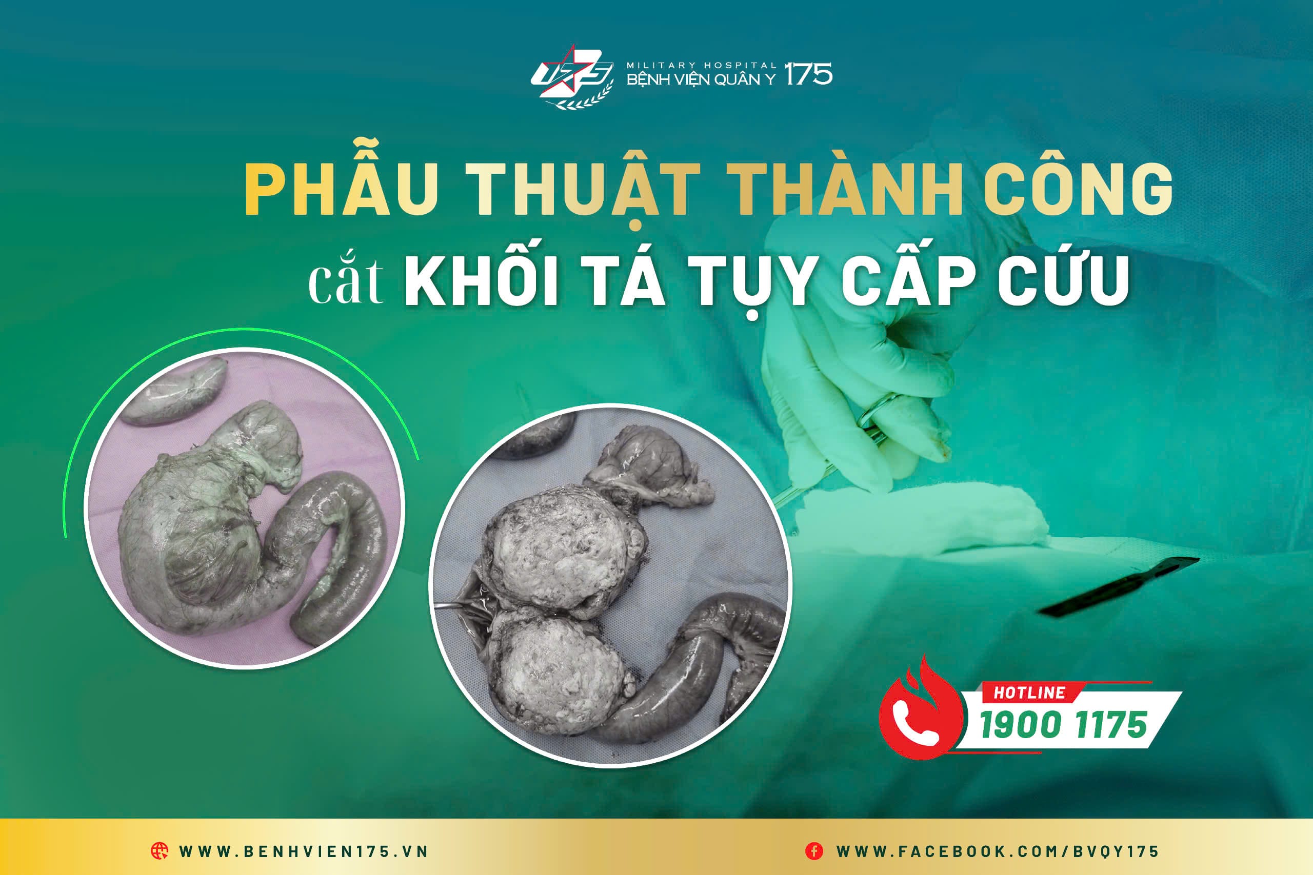 Phẫu thuật thành công cắt khối tá tụy cấp cứu