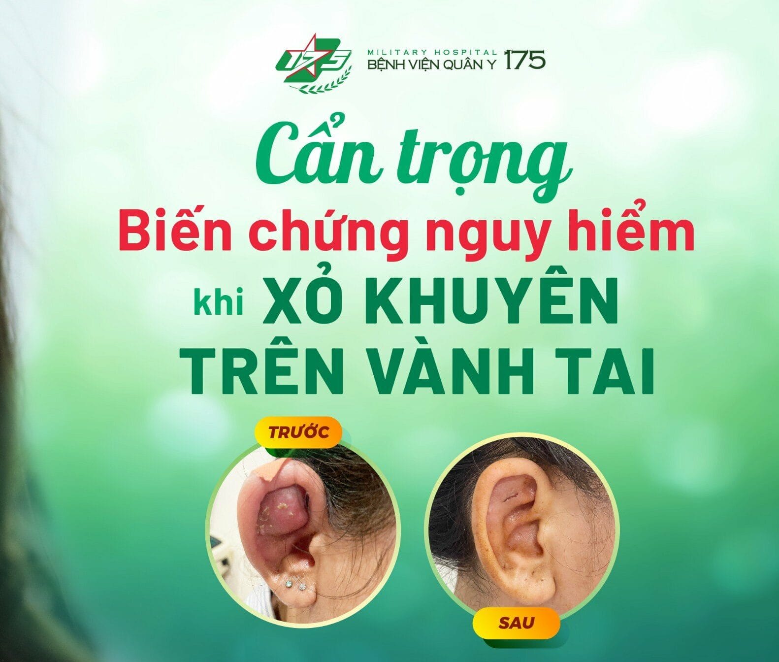 Cẩn trọng biến chứng nguy hiểm khi xỏ khuyên trên vành tai