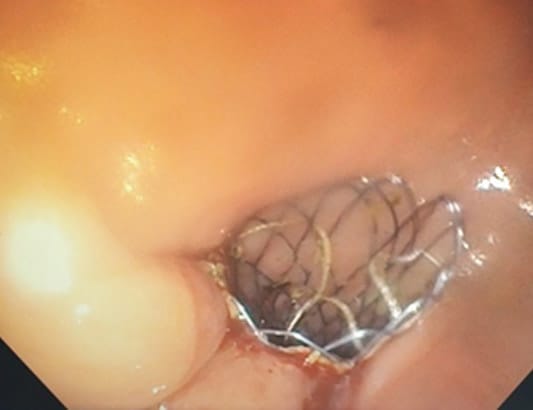 Bệnh viện Quân y 175 lần đầu tiên đặt thành công stent kim loại trong điều trị ung thư đại trực tràng